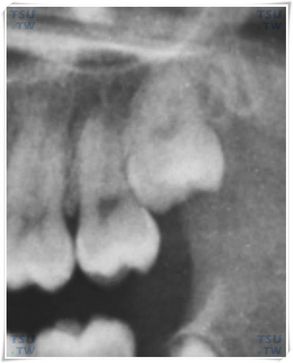  上颌垂直腭侧阻生智齿