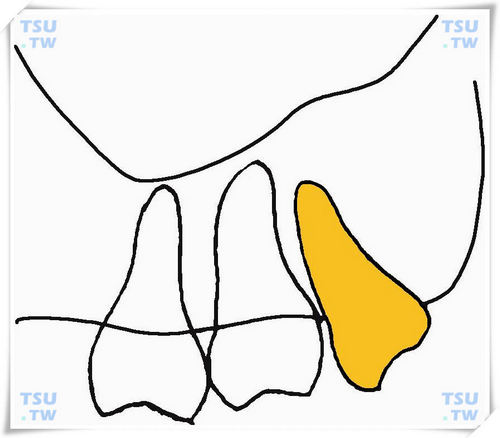  上颌间中垂直低位阻生智齿
