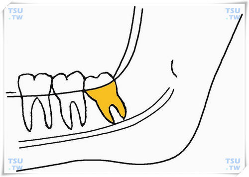  下颌近中倾斜高位阻生智齿