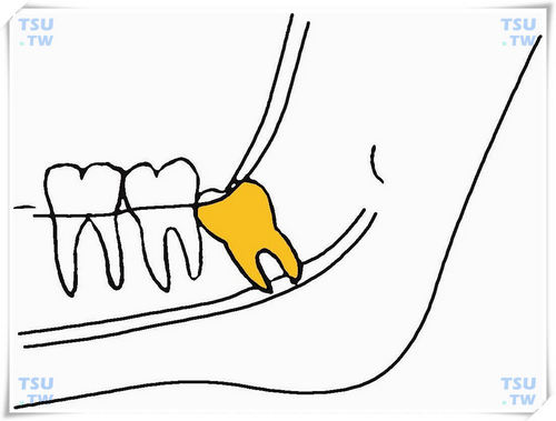  下颌近中倾斜中位阻生智齿