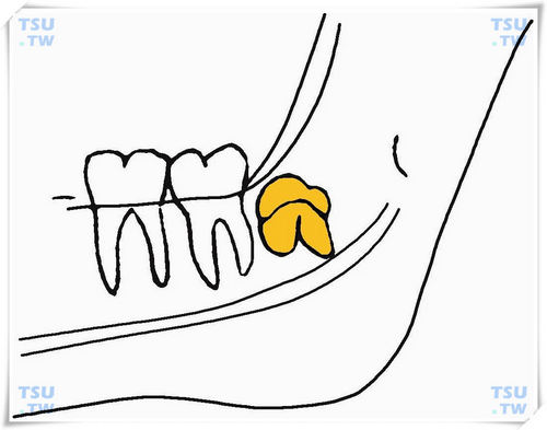  下颌颊侧上倾阻生智齿