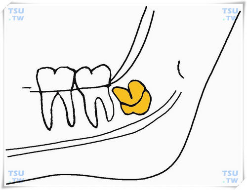  下颌颊侧下倾阻生智齿