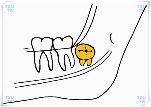  下颌舌侧上倾阻生智齿