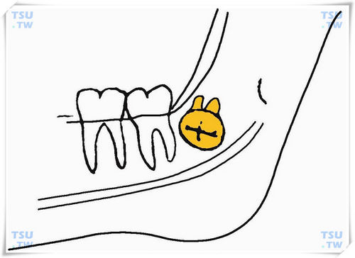  下颌舌侧下倾阻生智齿
