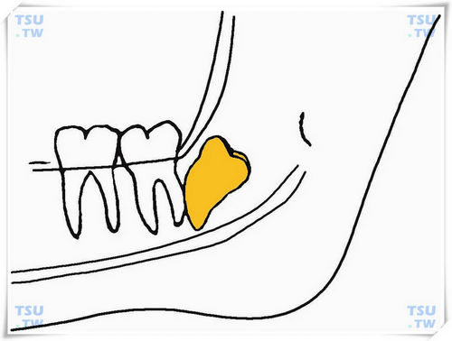  下颌反向上倾中位阻生智齿