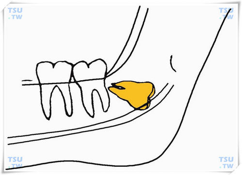  下颌反向下倾低位阻生智齿