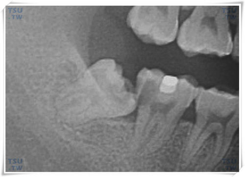  下颌近中倾斜高位阻生智齿