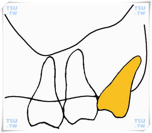  上颌近中倾斜低位阻生智齿