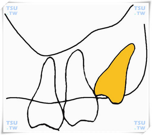  上颌近中倾斜中位阻生智齿