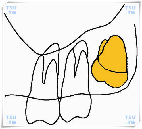  上颌颊侧下倾中位阻生智齿