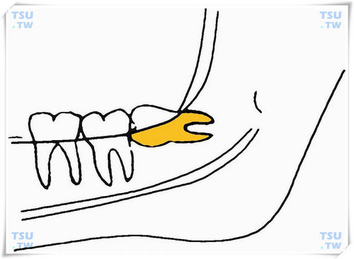  下颌近中高位水平阻生智齿