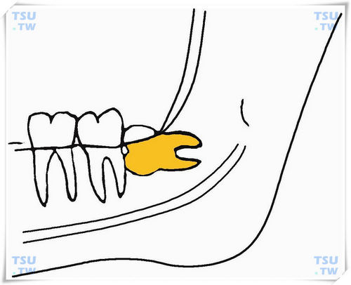 下颌近中中位水平阻生智齿