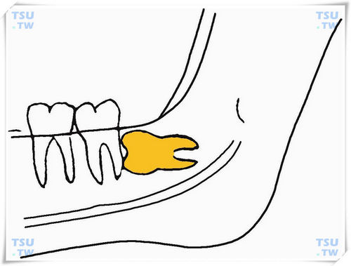  下颌近中低位水平阻生智齿