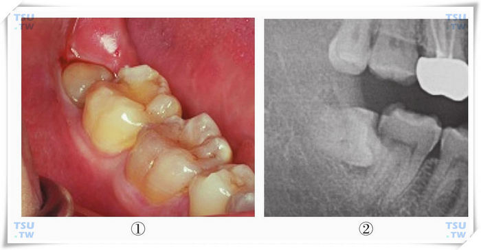 骨埋伏阻生智齿图片