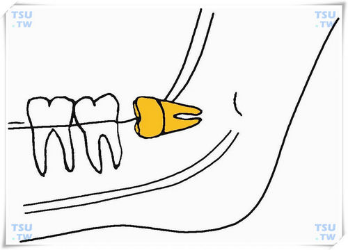  下颌间中高位水平阻生智齿