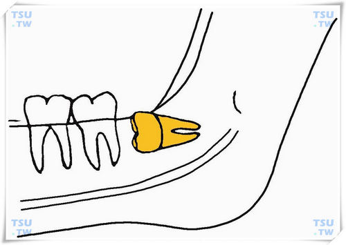  下颌间中中位水平阻生智齿