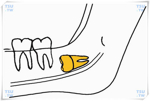  下颌间中低位水平阻生智齿