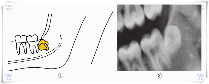  下颌颊向水平中位阻生智齿