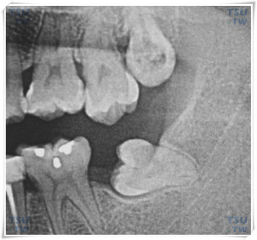 下颌水平阻生智齿（下牙横着长的智齿）