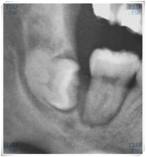  下颌间位水平低位阻生智齿