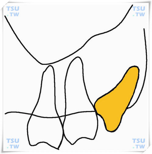  上颌近中低位水平阻生智齿