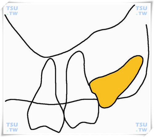  上颌近中中位水平阻生智齿