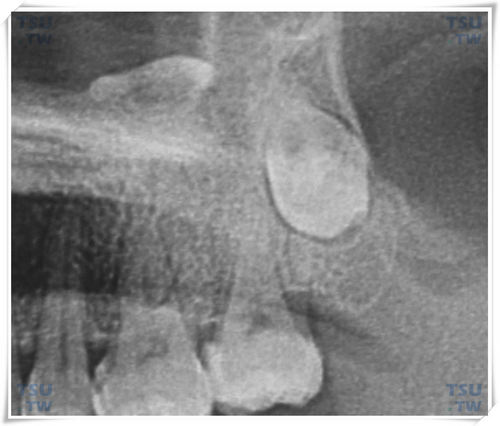  上颌颊向高位水平阻生智齿