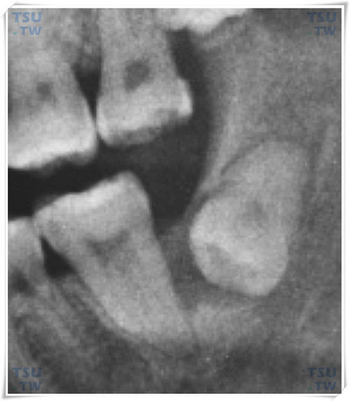  下颌间中倒逆下倾低位阻生智齿