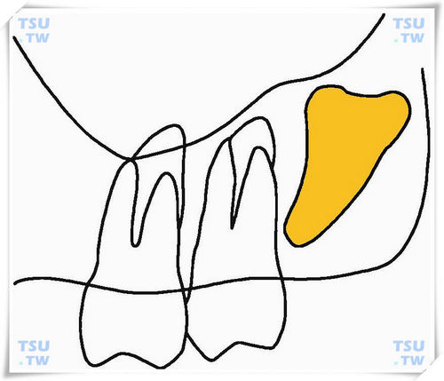  上颌间位倒逆垂直高位阻生智齿