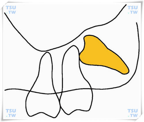  上颌近中倒逆上倾高位阻生智齿