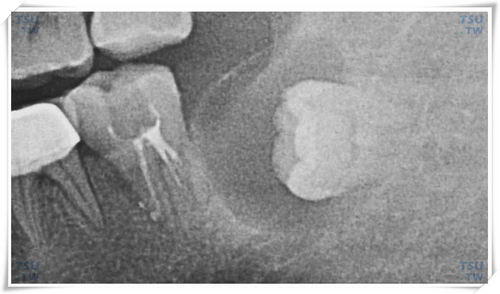  下颌间中水平低位阻生智齿