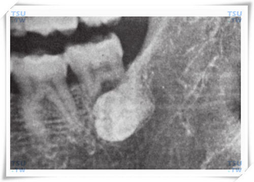 这智齿长的匪夷所思：异位埋伏阻生智齿