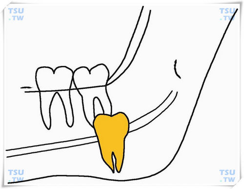  下颌前方低位垂直阻生智齿