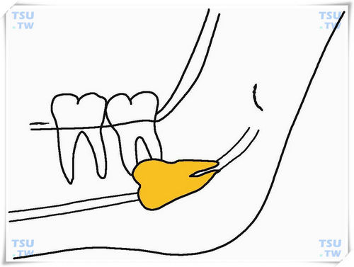  下颌前方近中低位水平阻生智齿