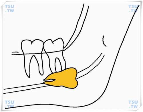  下颌前方间位反向低位水平阻生智齿