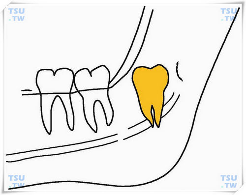  下颌后方垂直高位阻生智齿