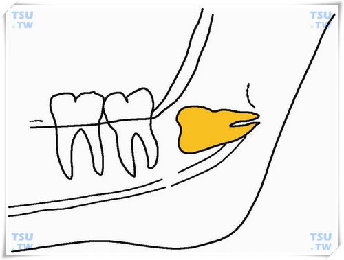  下颌远中低位水平阻生智齿