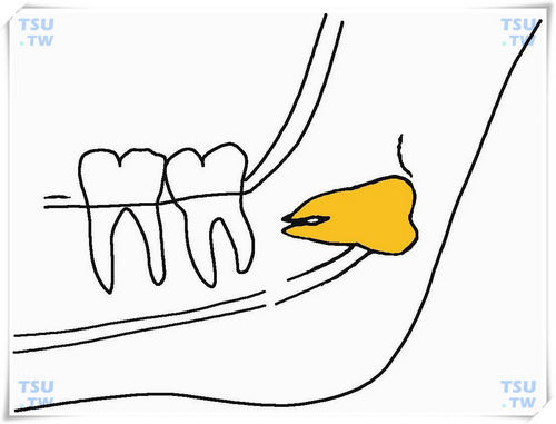  下颌远中反向低位水平阻生智齿