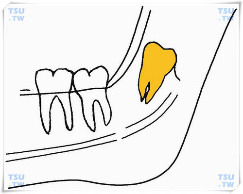  下颌上方高位上倾阻生智齿