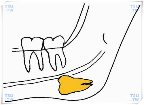  下颌下方水平低位阻生智齿