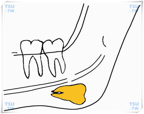  下颌下方反向水平阻生智齿