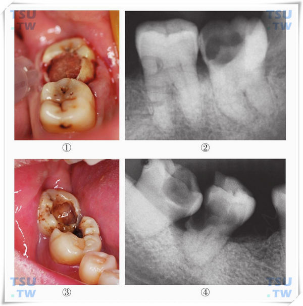 智齿没有拔除出现第二、三磨牙龋坏