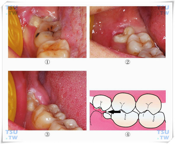 智齿导致的冠周炎