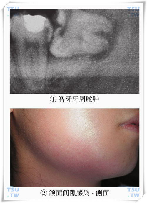    智齿引发颌周间隙感染