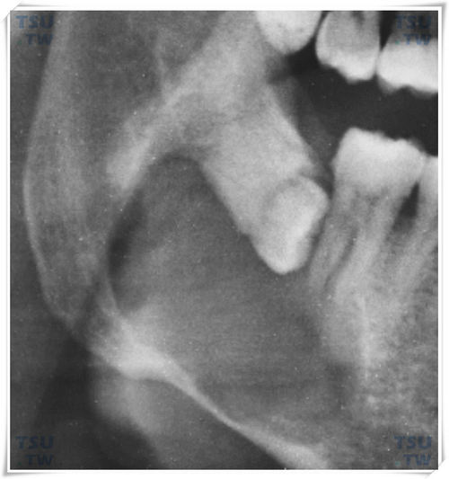  智齿引起囊肿X线片
