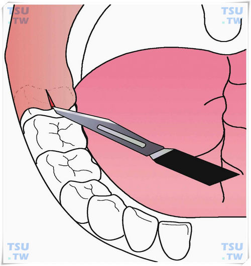  智齿冠周炎盲袋切开法（用尖刀挑开盲袋）