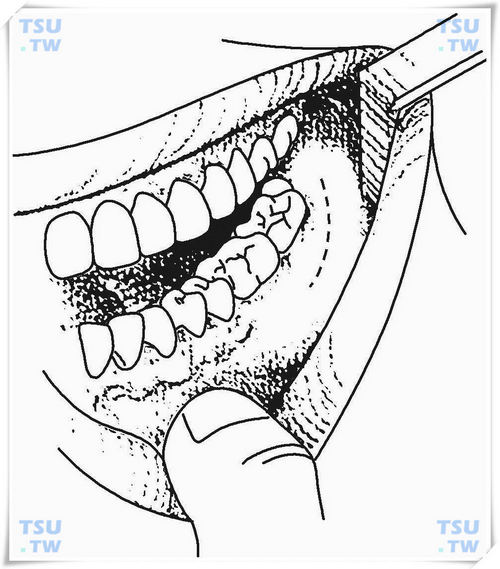  颊间隙感染口内切口
