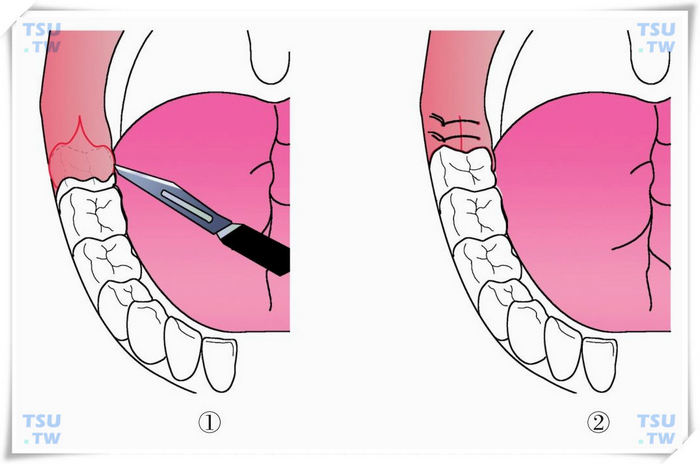  龈瓣切除术（切除范围及切除缝合后）