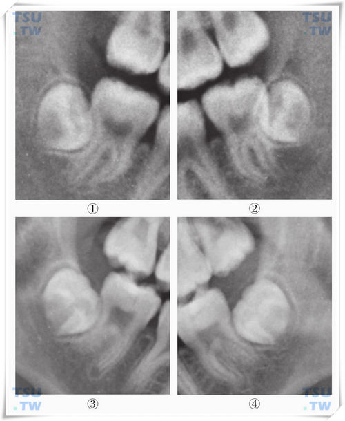 智齿冠颈形成期X线片