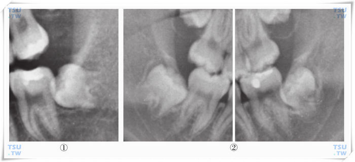 智齿根形成早期X线片